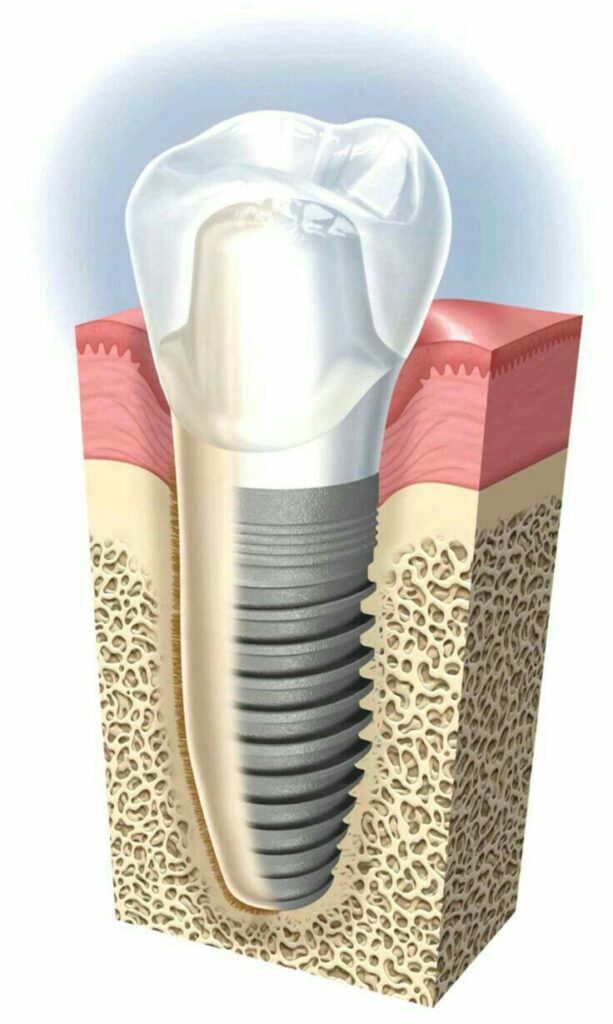 CIRURGIA ORAL I IMPLANTOLOGIA